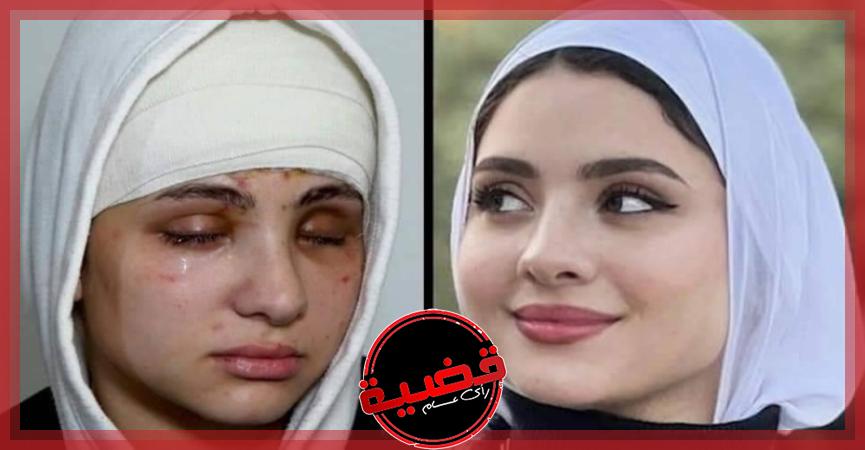 بعد العملية الجراحية في عينيها.. الأطباء يصدمون البلوجر  الحسناء سارة محمد _صور